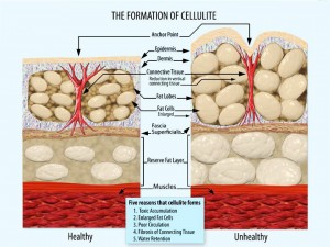 Cause-and-Formation-of-Cellulite